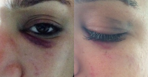Myriam Ruth, 22 anos, mostra hematomas após denunciar agressão sofrida por homem dentro de bar em área nobre de Belém. (Foto: Reprodução)