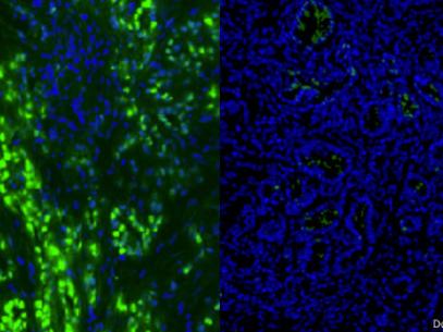 À esquerda, células de câncer no pâncreas aparecem em verde. Após o tratamento de seis dias (dir.), elas desapareceram Foto: Douglas Fearon / Universidade de Cambridge / Divulgação